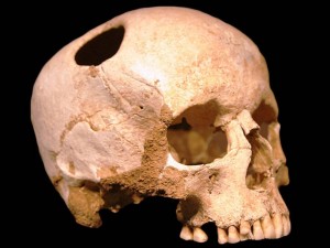 trepannated-skull-neolithic